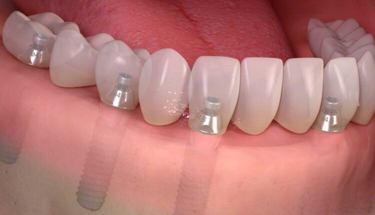 Implante dentário 1