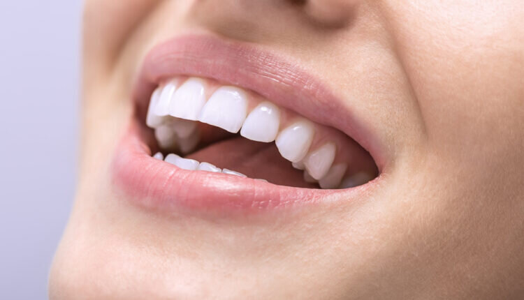 Como clarear dentes de forma caseira e segura - Reprodução Canva