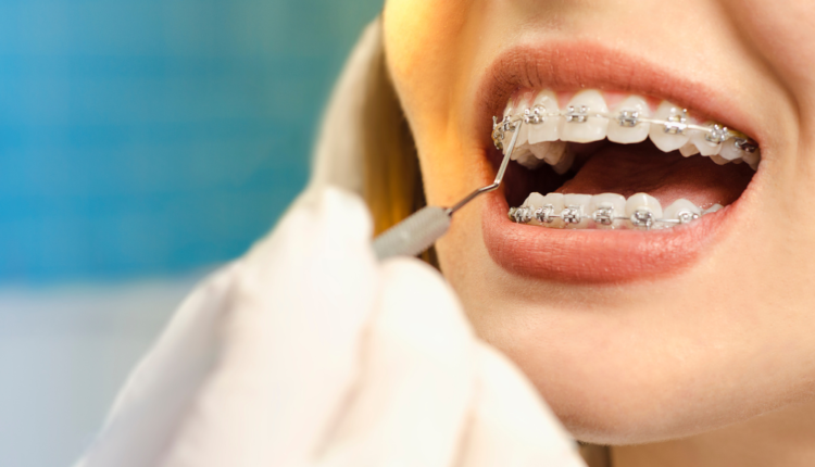 colocar aparelho nos dentes