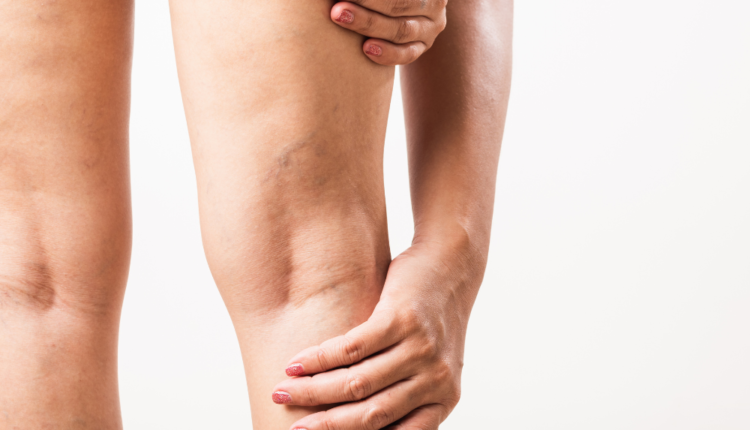 4 dicas para evitar o inchaço nas pernas no fim do dia